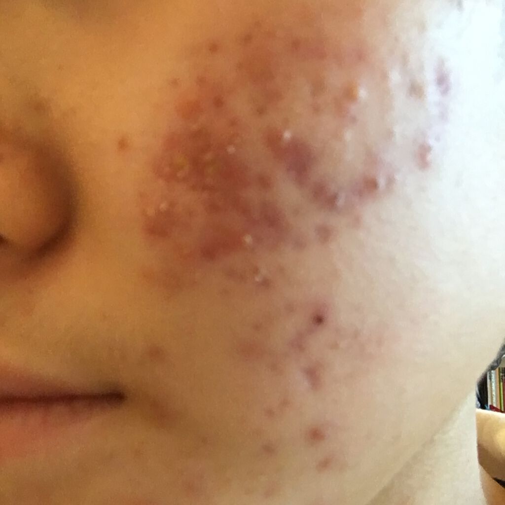 オロナインH軟膏 (医薬品)/オロナイン/その他を使ったクチコミ(3枚目)