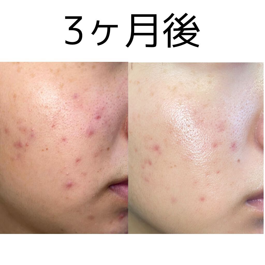 潤浸保湿 化粧水 III とてもしっとり/キュレル/化粧水を使ったクチコミ（2枚目）