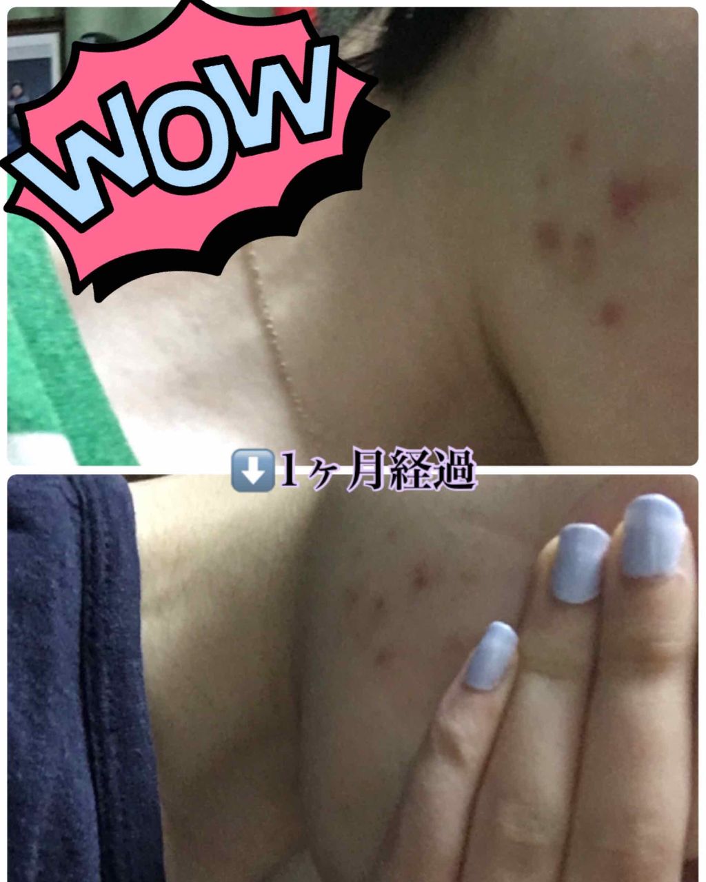 AC アクネローション/BENEFIQUE/ミスト状化粧水を使ったクチコミ(3枚目)