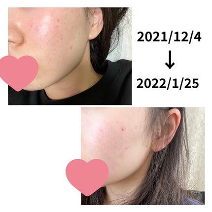 メディプローラー CO2ジェルマスク/ドクターメディオン/洗い流すパック・マスクを使ったクチコミ(1枚目)