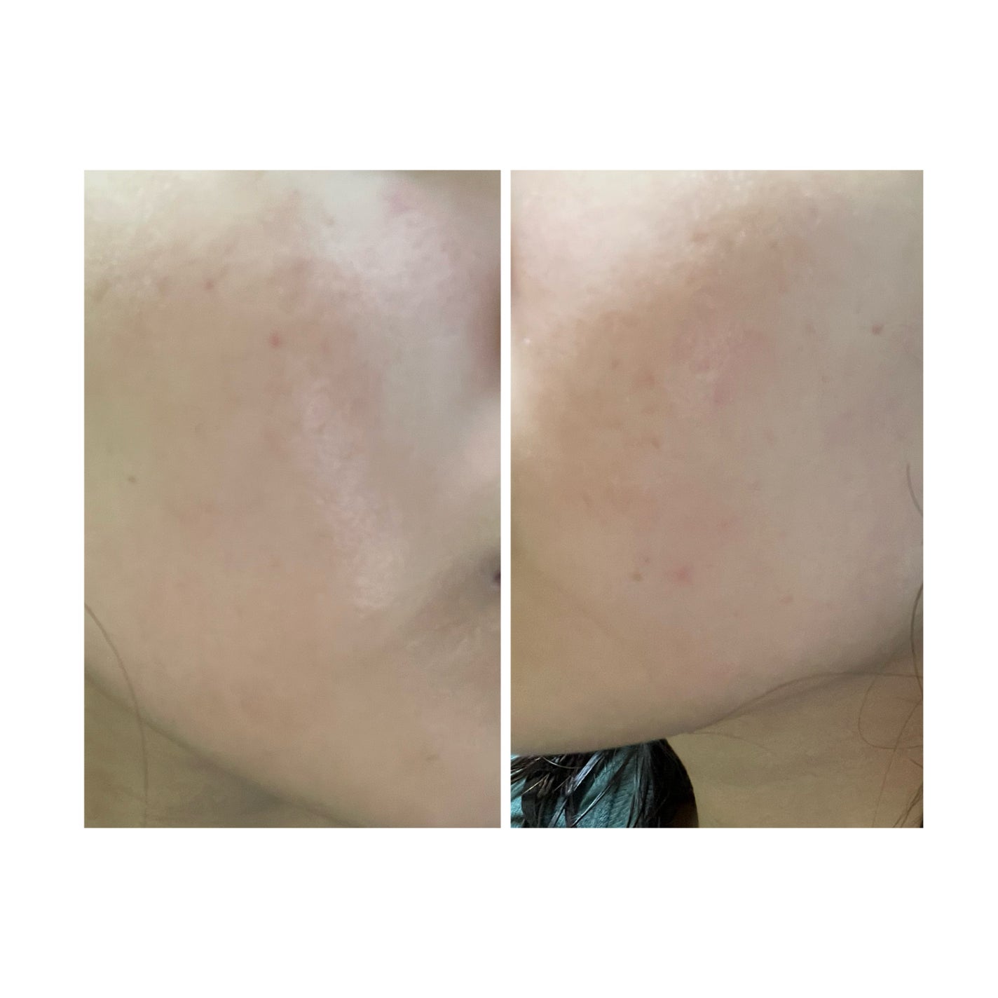 ぽむ on LIPS 「2023.9.13皮膚科に受診 エピデュオとヘパリン処方1枚目..」(2枚目)