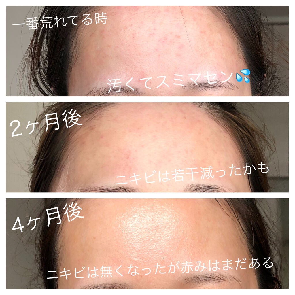 ハイポアレジェニック シカ ジェルクリーム/Dermatory/フェイスクリームを使ったクチコミ(6枚目)