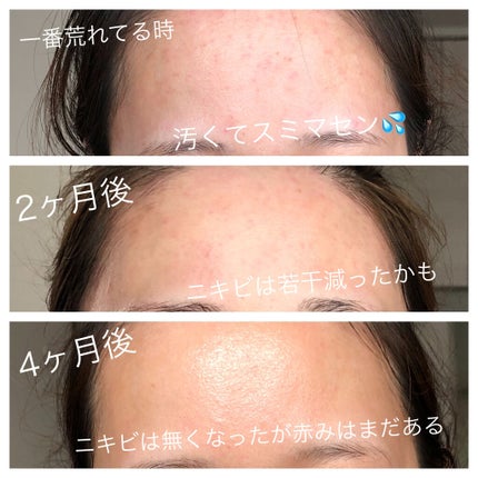 ハイポアレジェニック シカ ジェルクリーム/Dermatory/フェイスクリームを使ったクチコミ(6枚目)