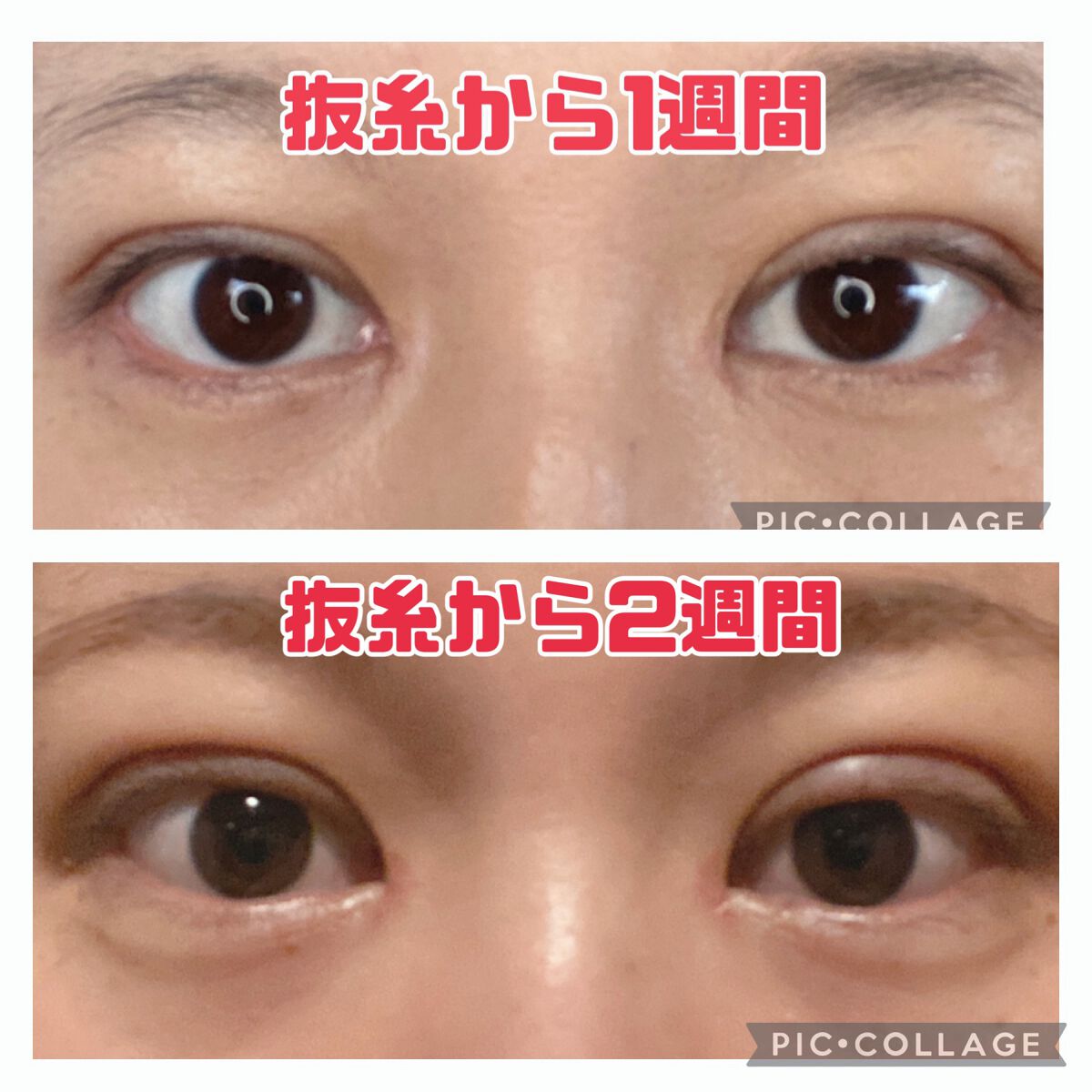 ふうせん @フォロバ100% on LIPS 「3月17日抜糸から2週間今日は、ちょっと腫れてました。その日の..」(1枚目)