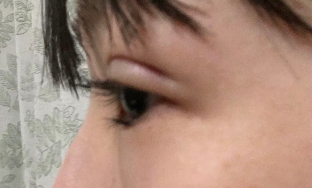 さにょん🍎 on LIPS 「③整形後1日目です。なんだか当日よりも痛々しく😥昨日はなかった..」(3枚目)