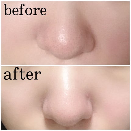 チョコブラ スペシャル毛穴ケアセット/Chocobra/スキンケアキットを使ったクチコミ(5枚目)