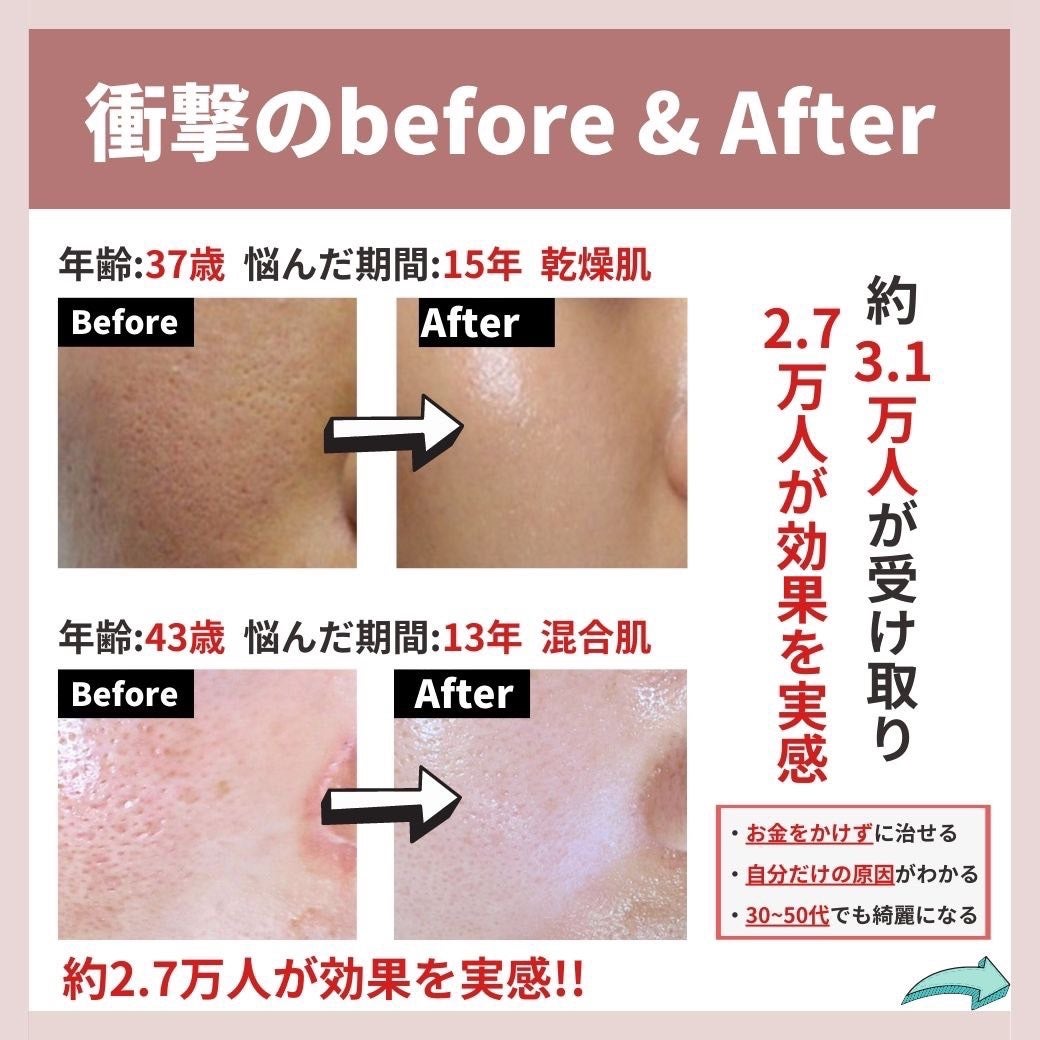 あなたの肌に合ったスキンケア💐コーくん先生 on LIPS 「【9割が間違えてる】こんな人は毛穴の開きが一生消えません😭.
..」(7枚目)