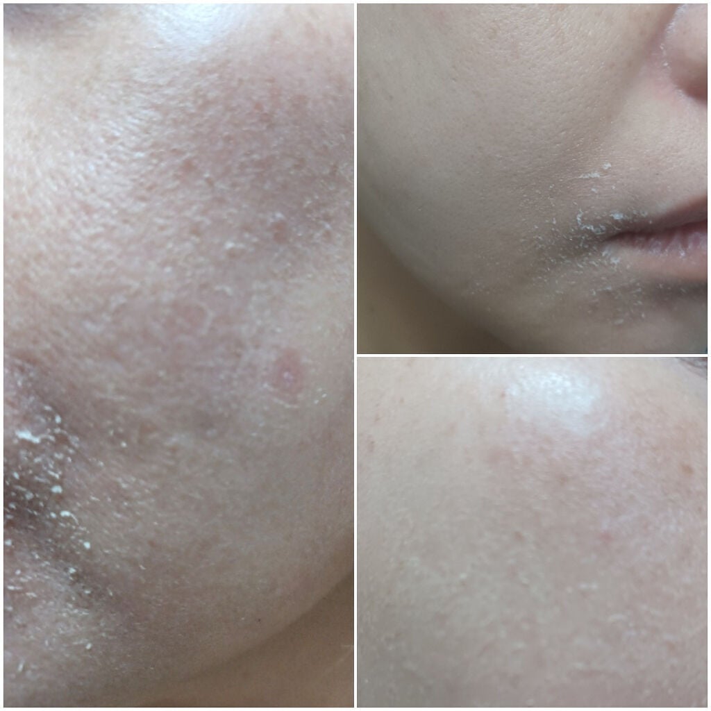 バブ美 on LIPS 「ゼオスキンのセラピューティックを始めて1週間目の様子です。朝:..」(3枚目)