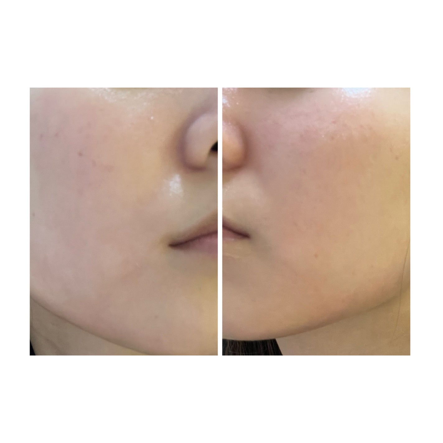 ぽむ on LIPS 「2023.9.13皮膚科に受診 エピデュオとヘパリン処方1枚目..」(5枚目)