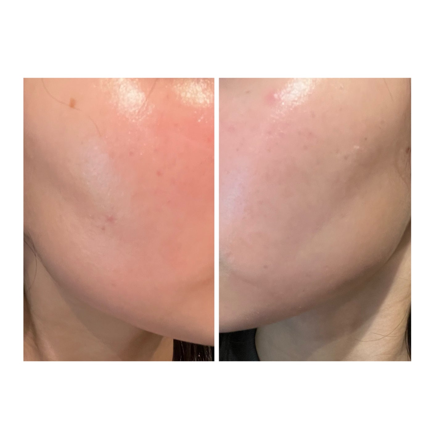 ぽむ on LIPS 「2023.9.13皮膚科に受診 エピデュオとヘパリン処方1枚目..」(2枚目)