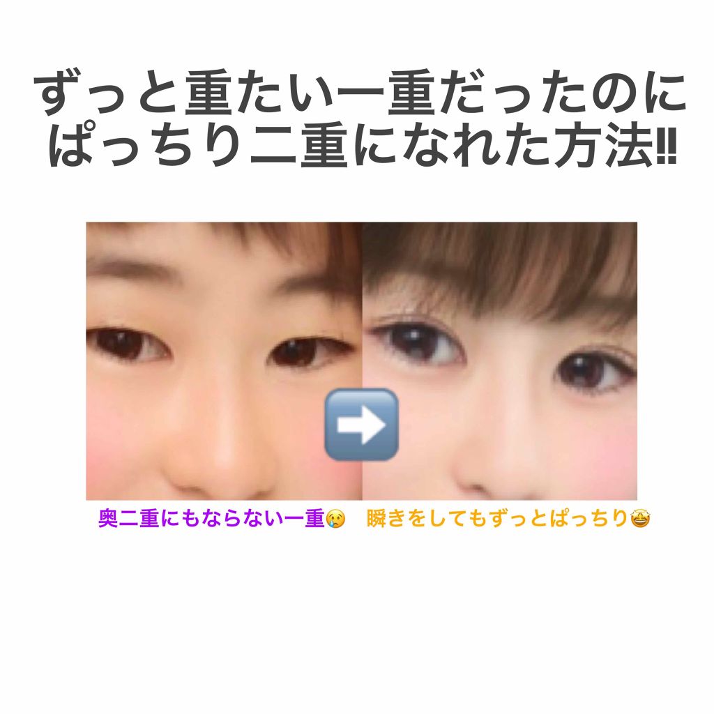 沙羅 on LIPS 「約1年半で二重になれた方法🦖初投稿です🙌🙌小学生~中2までずっ..」(1枚目)