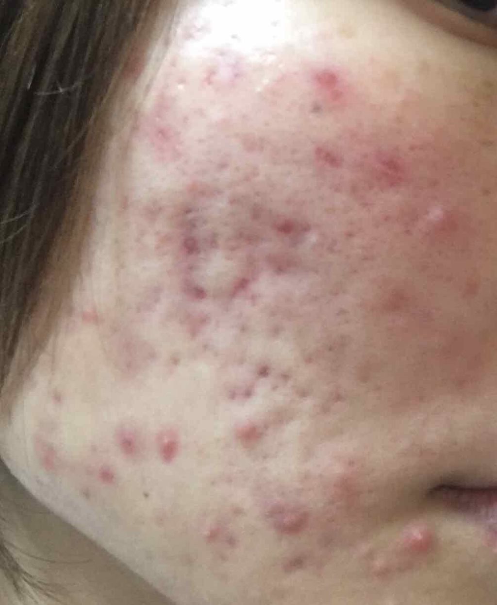 ささみ on LIPS 「!!閲覧注意!!ニキビ肌の写真があります今日から私のニキビ治療..」(2枚目)