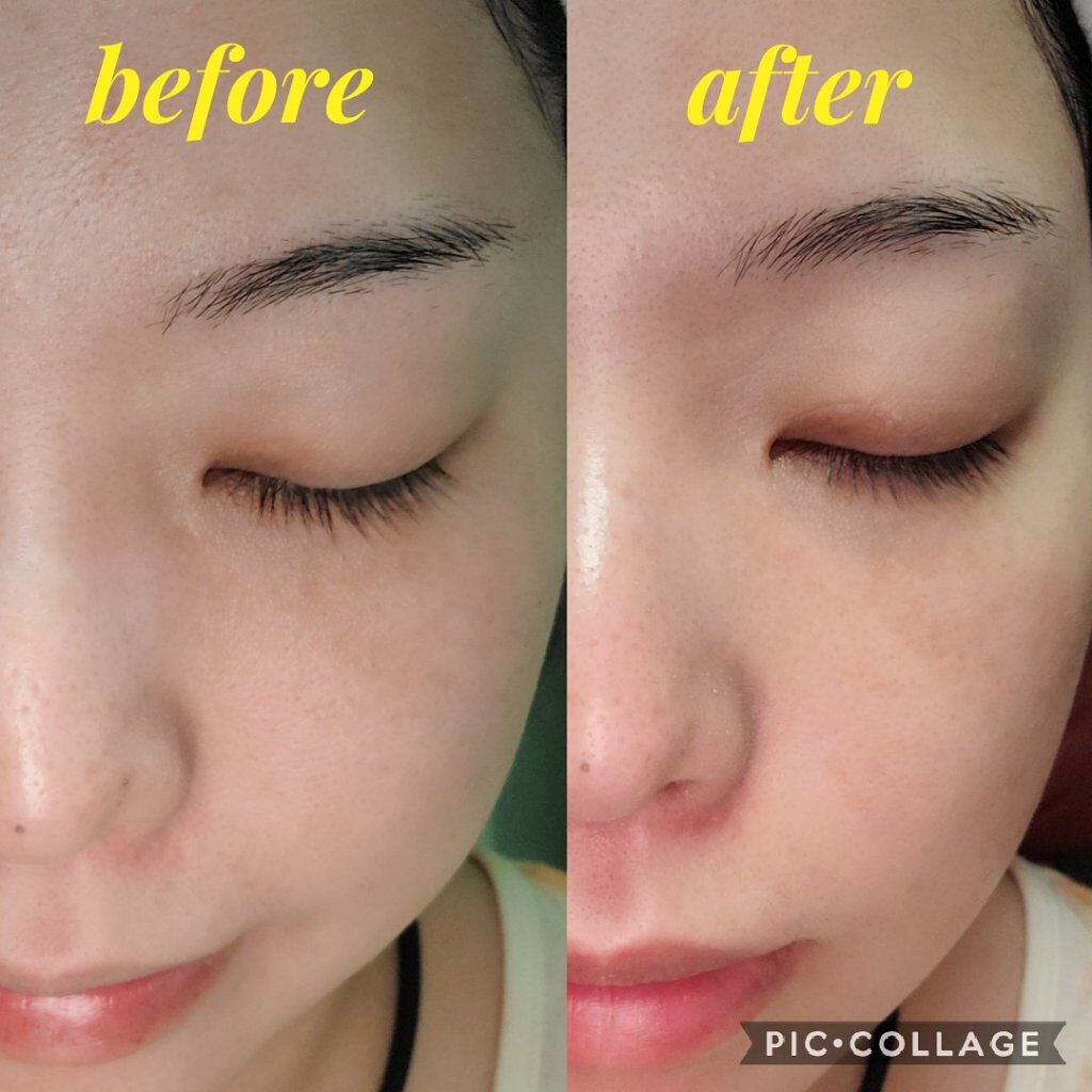 ネイチャーコンク 薬用クリアローション/ネイチャーコンク/拭き取り化粧水を使ったクチコミ(4枚目)