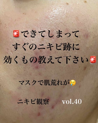 メラノCC 薬用 しみ 集中対策 美容液のクチコミ「⚠️教えてください！！⚠️

最近マスクをつけることが多いので、マスクが顔に当たるライン沿いに.....」（1枚目）