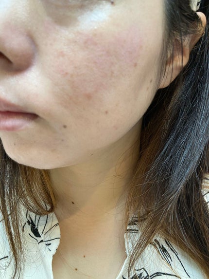 しい on LIPS 「カソーダ9日目特に変わりなし。皮向けもないし赤みもそれほど、、..」(3枚目)