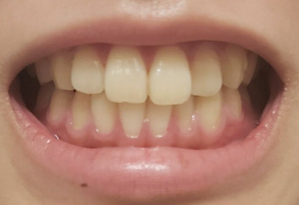 アパガードプレミオ/アパガード/歯磨き粉を使ったクチコミ（3枚目）