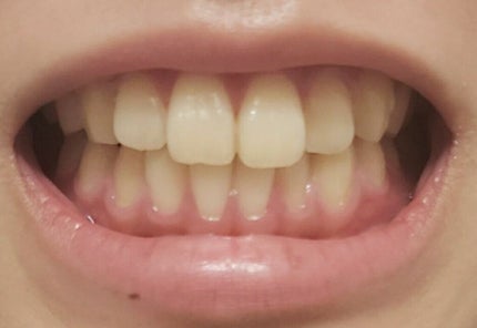 アパガードプレミオ/アパガード/歯磨き粉を使ったクチコミ(3枚目)