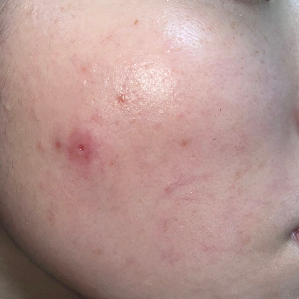 薬用しみ集中対策 プレミアム美容液/メラノCC/美容液を使ったクチコミ(3枚目)