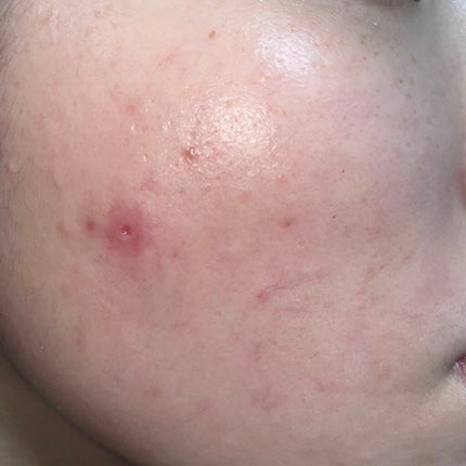 薬用しみ集中対策 プレミアム美容液/メラノCC/美容液を使ったクチコミ(3枚目)