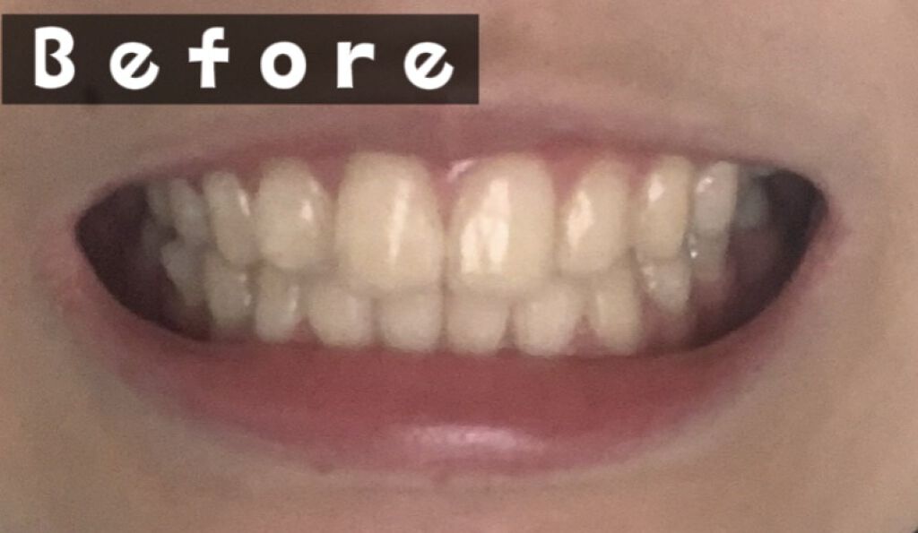 ホワイトニングスタートキット/SHINE SMILE/その他オーラルケアを使ったクチコミ（3枚目）