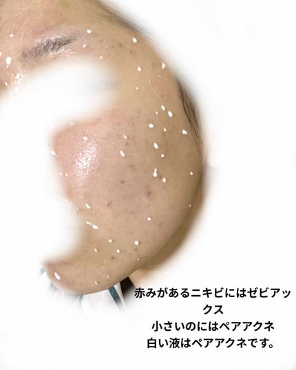 ペアアクネクリームW(医薬品)/ペア/その他を使ったクチコミ(4枚目)