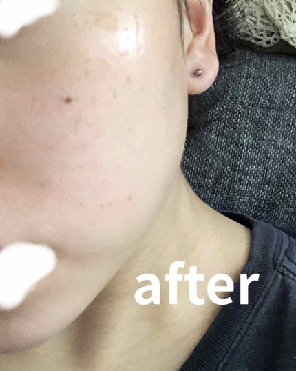 ベピオゲル/マルホ株式会社/その他を使ったクチコミ(3枚目)