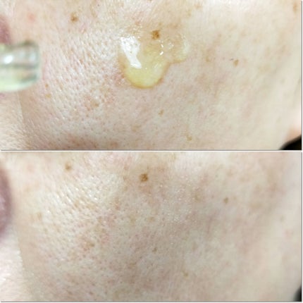 ビタコラーゲン ブライトニング アンプル/ダーマフィックス/美容液を使ったクチコミ(4枚目)