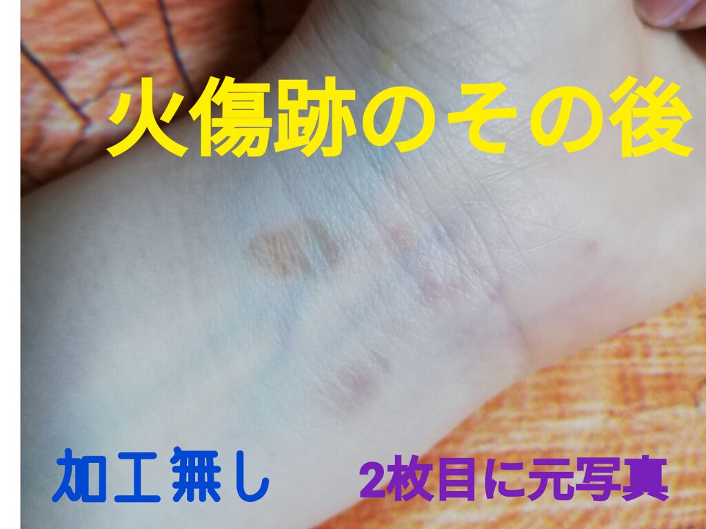 オロナインｈ軟膏 医薬品 オロナインの口コミ 火傷跡にオロナインを塗り続けた結果 By Maya Instagram Maa Yaa 敏感肌 30代後半 Lips