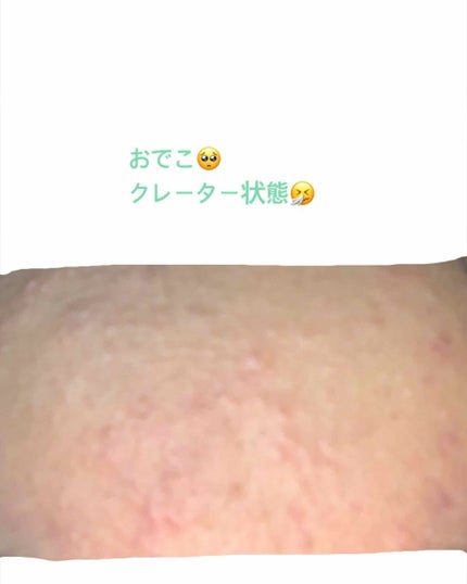 ペアアクネクリームW(医薬品)/ペア/その他を使ったクチコミ(3枚目)