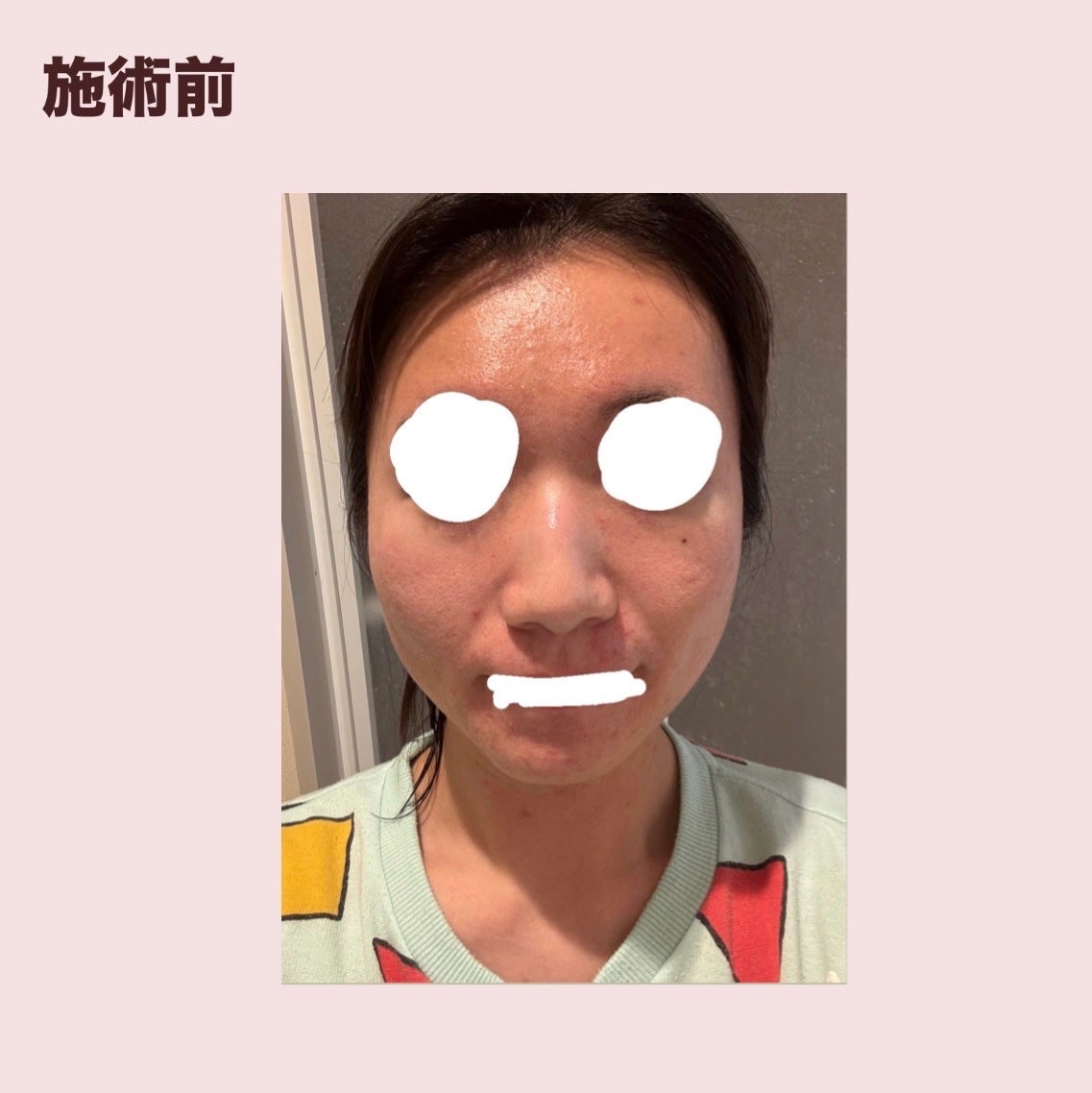 お芋ちゃん|10年以上ニキビに悩む保育士 on LIPS 「サリチル酸ピーリングを受けてきました。最近花粉の影響なのかおで..」(3枚目)