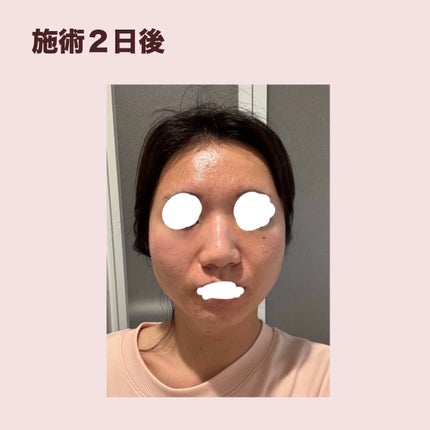 お芋ちゃん|10年以上ニキビに悩む保育士 on LIPS 「サリチル酸ピーリングを受けてきました。最近花粉の影響なのかおで..」(4枚目)