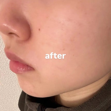 Lily on LIPS 「【花粉による肌荒れ対策に☀️】レッドブレミッシュシリーズの2種..」(4枚目)