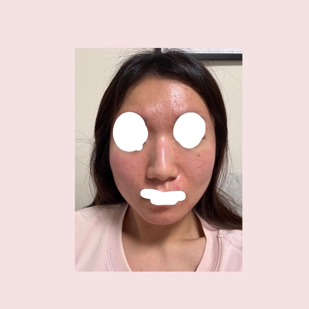 お芋ちゃん|10年以上ニキビに悩む保育士 on LIPS 「エレクトロポレーション(ケアシス)を受けてきました!!美容成分..」(3枚目)