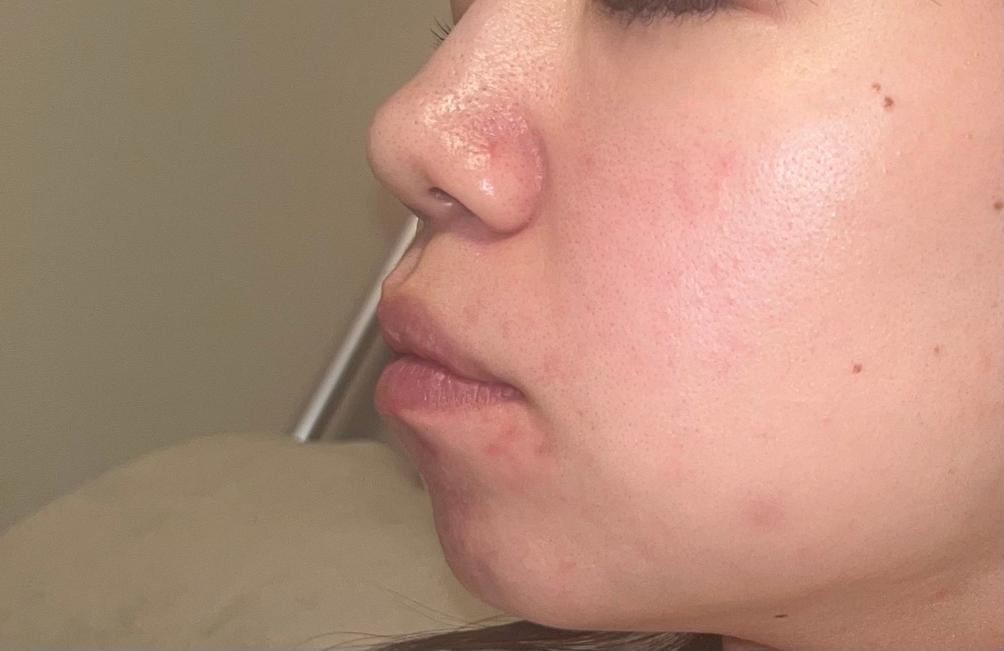 A アクネフォーム/NOV/洗顔フォームを使ったクチコミ(4枚目)