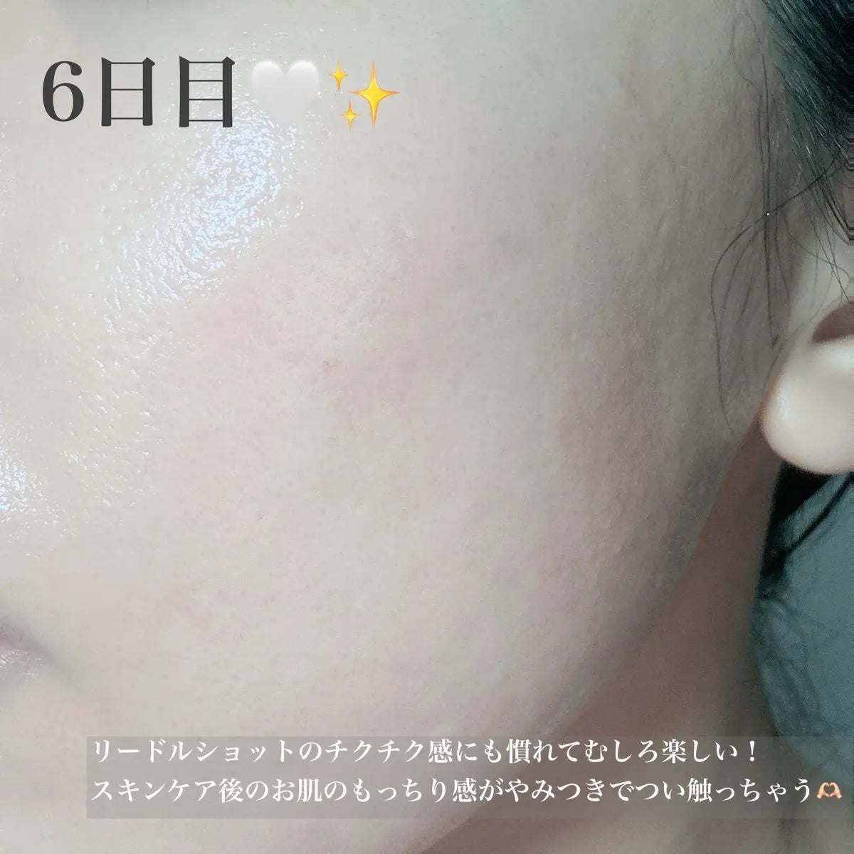 リードルショット300/VT/美容液を使ったクチコミ(2枚目)