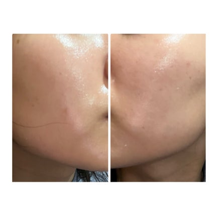 ぽむ on LIPS 「2023.9.13皮膚科に受診 エピデュオとヘパリン処方1枚目..」(4枚目)