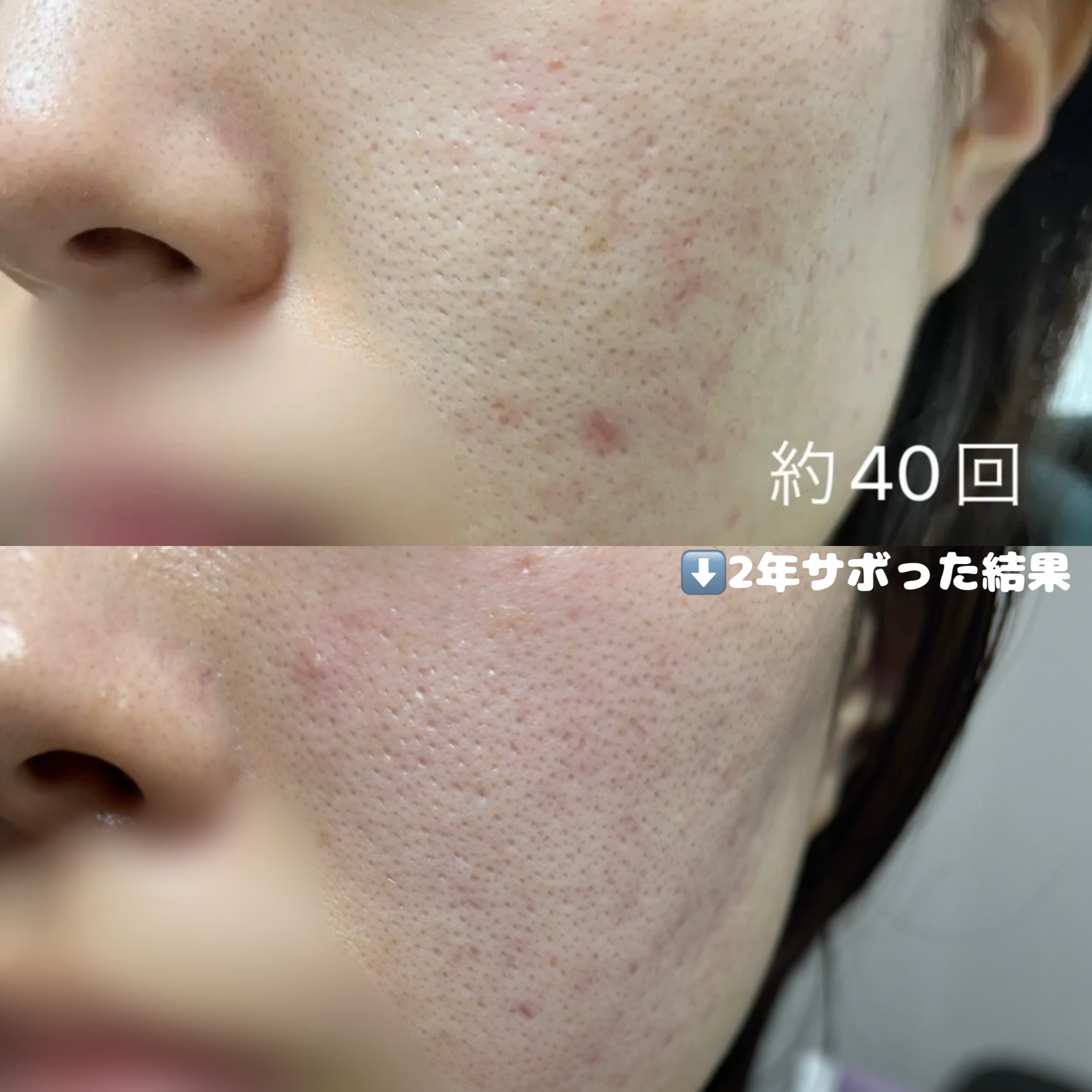 AGE-Rダーマエアショット｜MEDICUBEの口コミ - ダーマエアショットの