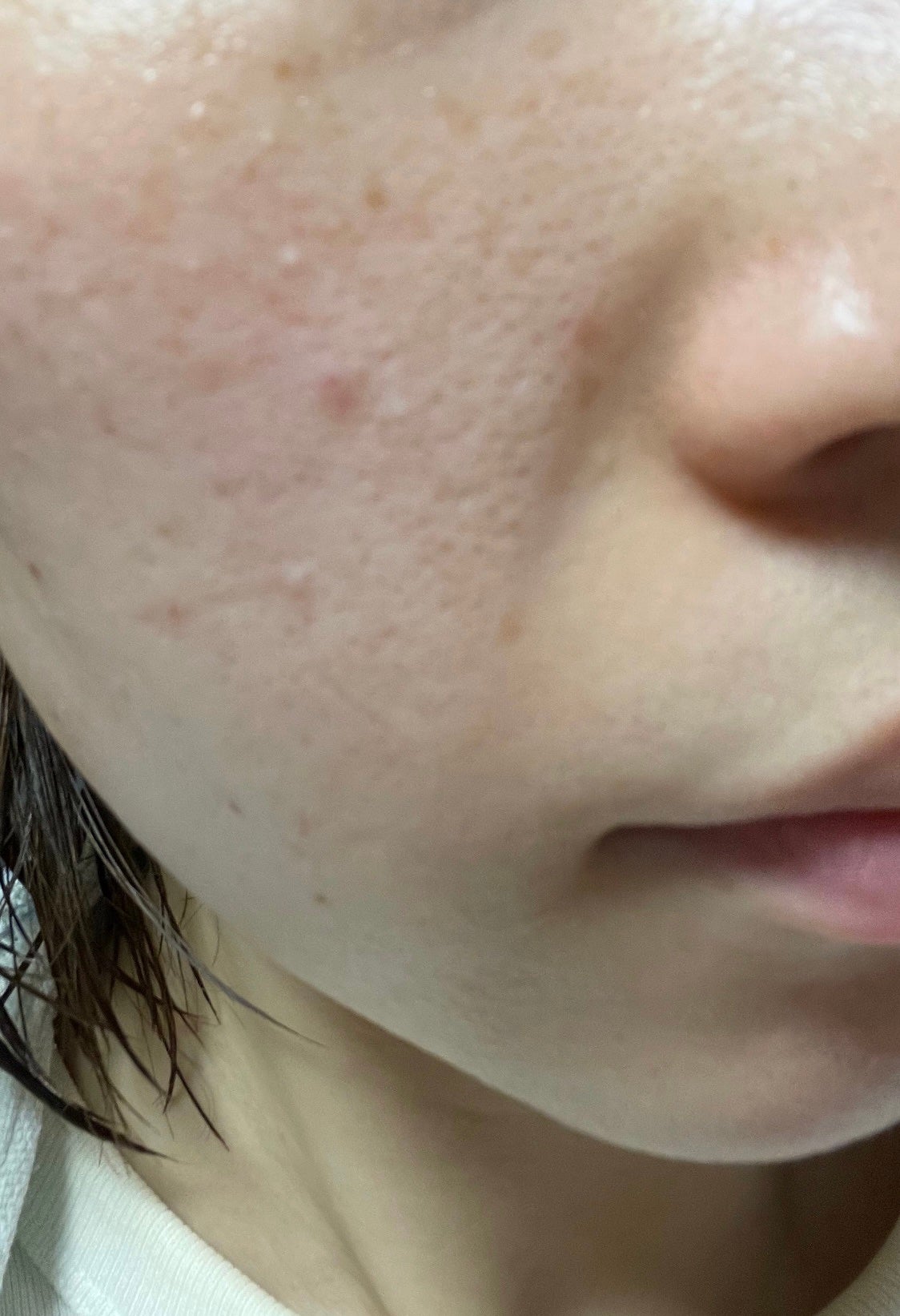 しか on LIPS 「肌質改善したいので記録します。なるべくホームケアでのみで肌治安..」(2枚目)