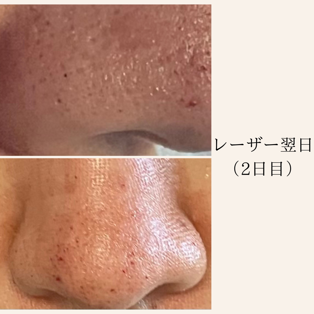 アルティミューン™ パワライジング セラム/SHISEIDO/美容液を使ったクチコミ（2枚目）