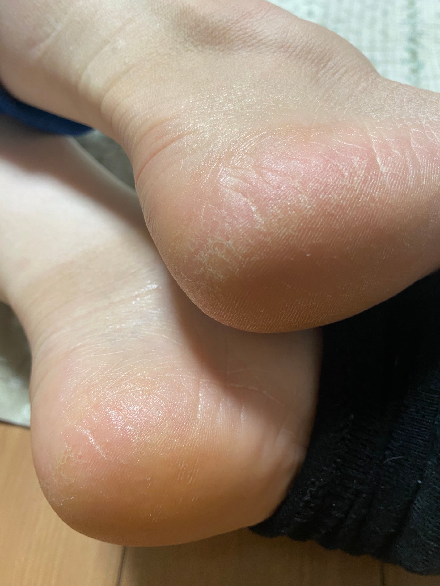 MOMO on LIPS 「【使った商品】足小路麗子👣⸒⸒【商品の特徴】乾燥でひび割れた皮..」(5枚目)