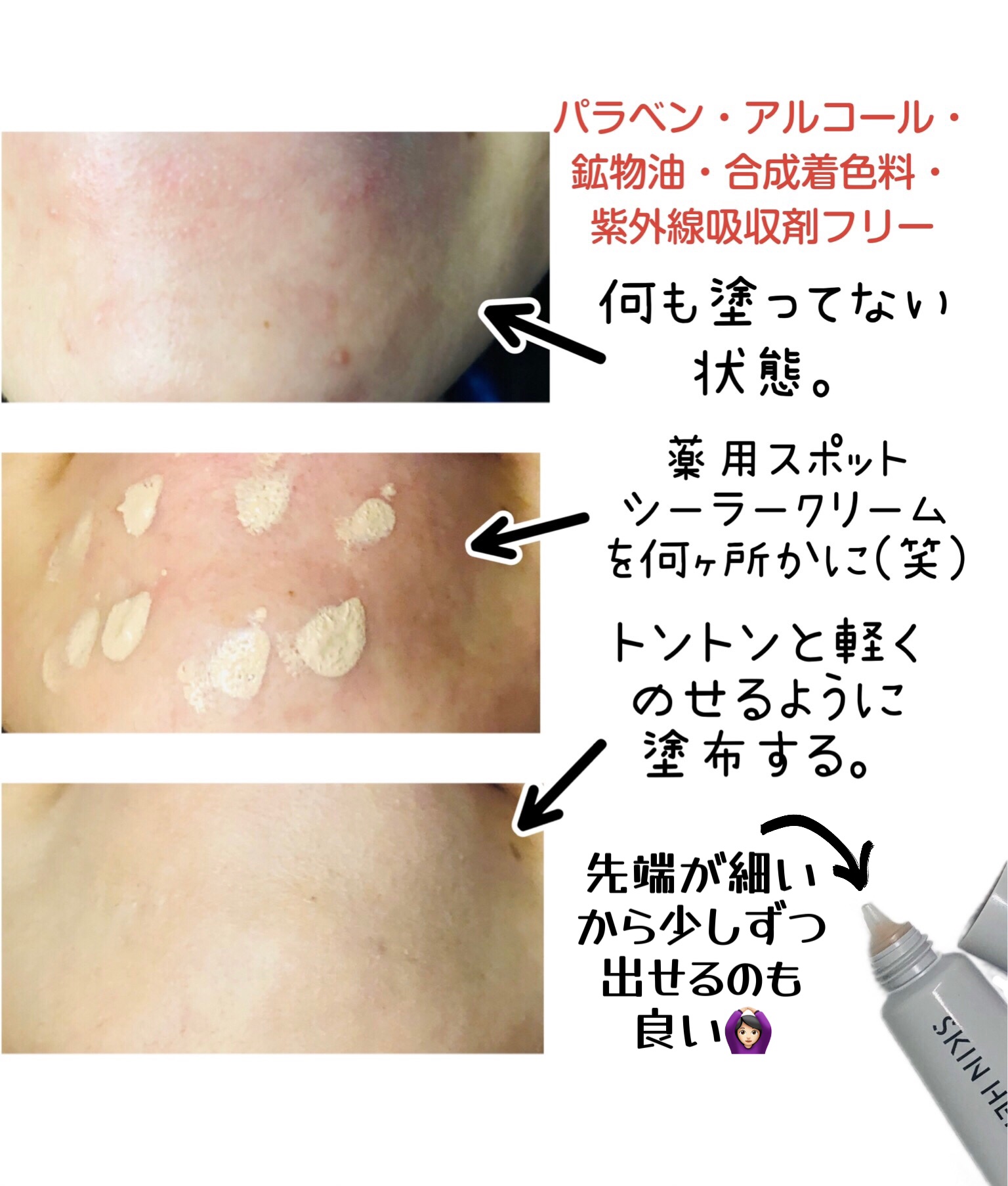 薬用スポットシーラークリーム/スキンヒーロー/クリームコンシーラーを使ったクチコミ（3枚目）