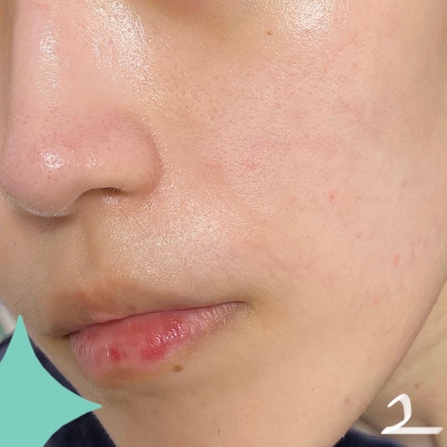 レチノール0.3 ナイアシンリニューイングセラム/Anua/美容液を使ったクチコミ(4枚目)