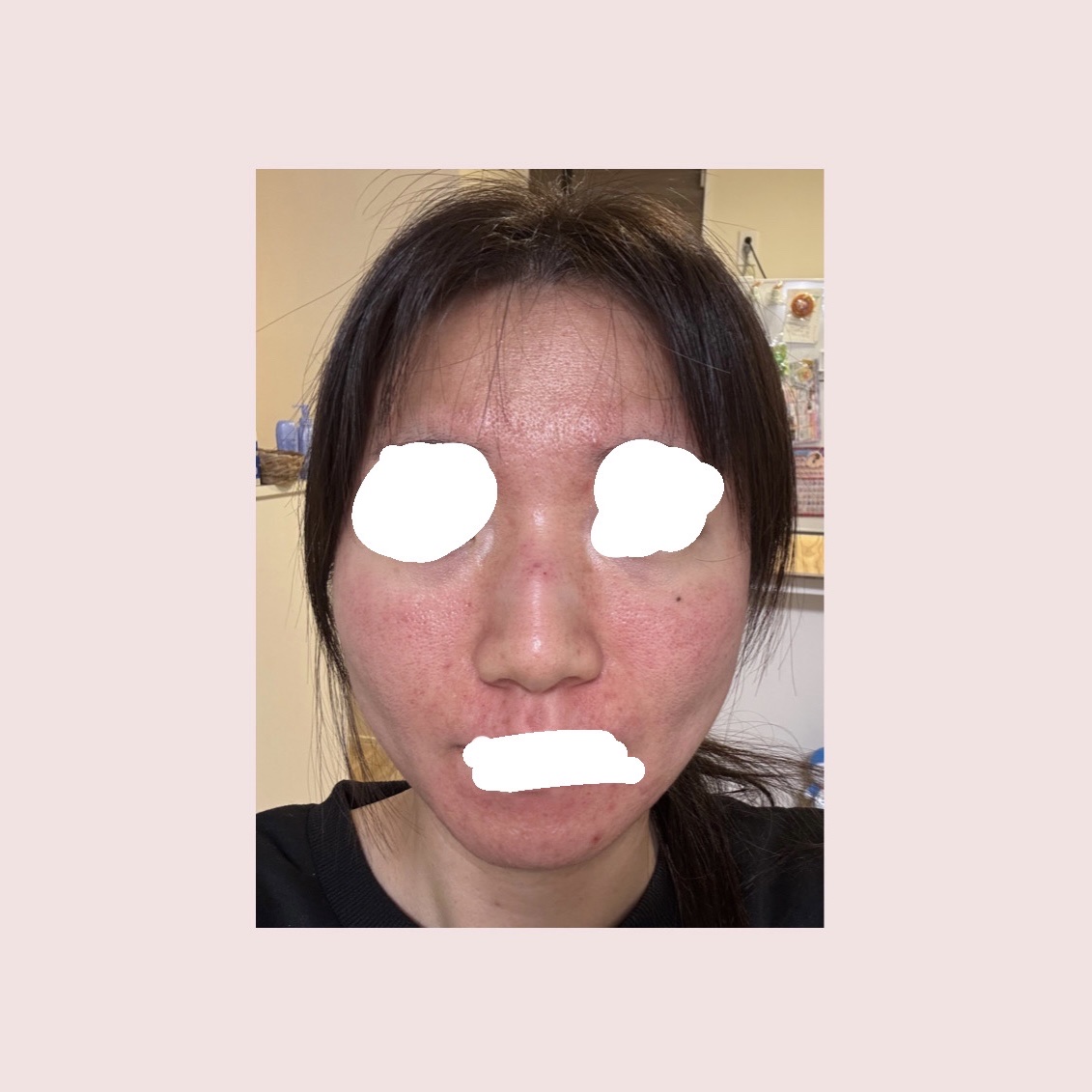 DRX AZAクリア/ロート製薬/その他スキンケアを使ったクチコミ（3枚目）