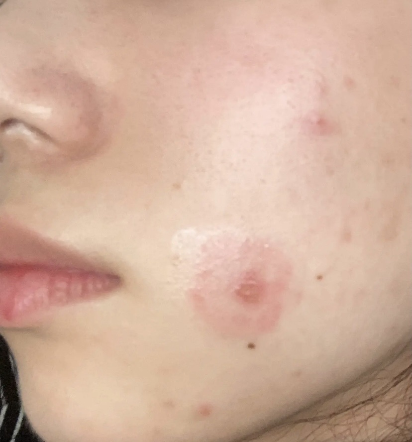 メンソレータムアクネス 薬用クリーム洗顔/メンソレータム アクネス/洗顔フォームを使ったクチコミ（2枚目）