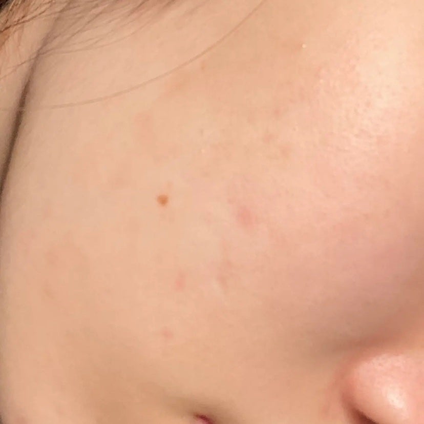 「肌荒れ治すぞ」ひよこ🐣フォロバ100 on LIPS 「🌸肌荒れ日記2日目昨日酷かったとこがだいぶ治ってきました💖ニキ..」(3枚目)