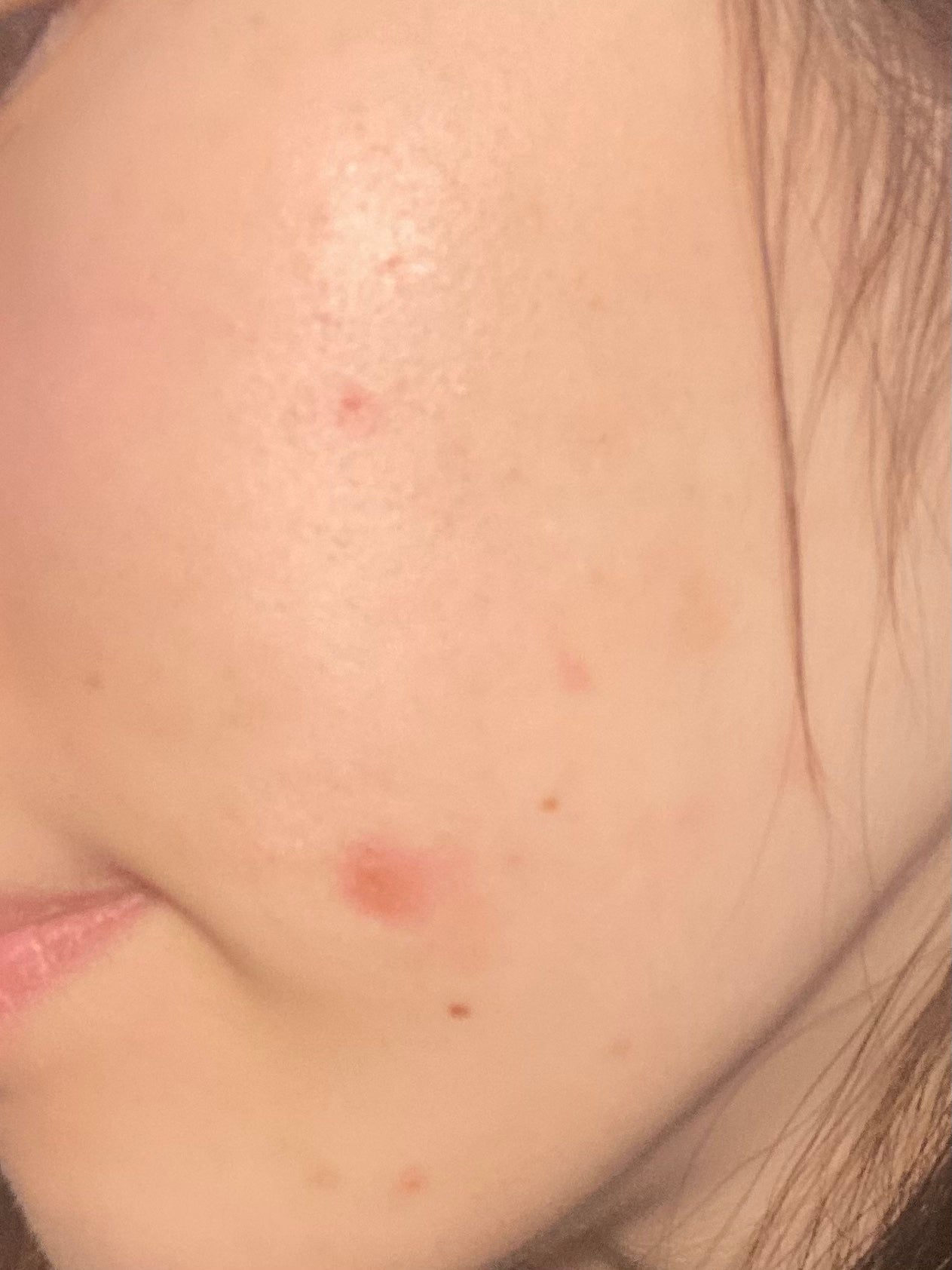 「肌荒れ治すぞ」ひよこ🐣フォロバ100 on LIPS 「🌸肌荒れ日記3日目肌を綺麗にしたく、毎日肌の写真投稿してます🩷..」(2枚目)