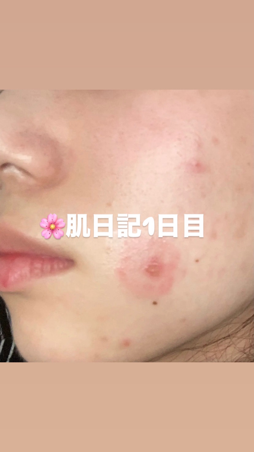 メンソレータムアクネス 薬用クリーム洗顔/メンソレータム アクネス/洗顔フォームを使ったクチコミ（1枚目）