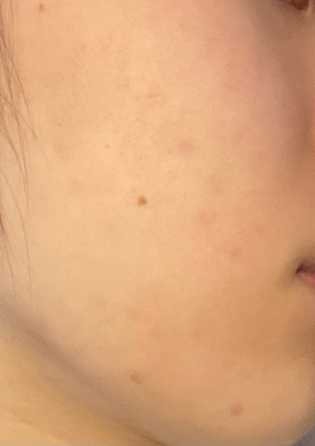 「肌荒れ治すぞ」ひよこ🐣フォロバ100 on LIPS 「🌸肌日記4日目毎日肌の写真あげてるので、暇な時覗きにきてくださ..」(3枚目)