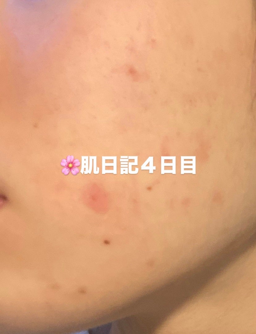 「肌荒れ治すぞ」ひよこ🐣フォロバ100 on LIPS 「🌸肌日記4日目毎日肌の写真あげてるので、暇な時覗きにきてくださ..」(1枚目)