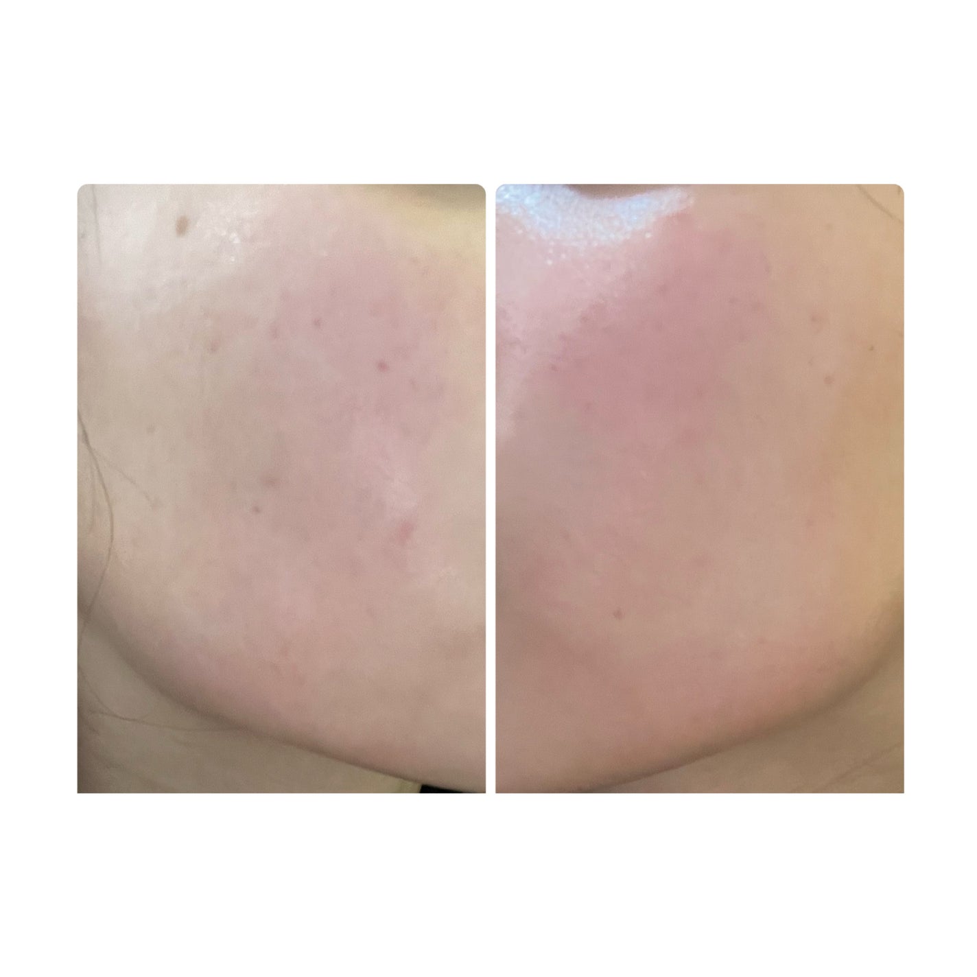 ぽむ on LIPS 「2023.9.13皮膚科に受診 エピデュオとヘパリン処方1枚目..」(1枚目)